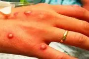 افزایش موارد ابتلا به آبله میمون در آمریکا