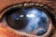 تفاوت آب سیاه چشم با آب مروارید چیست؟/درد، تهوع و تاریِ دید از عوارض آب سیاه چشم است