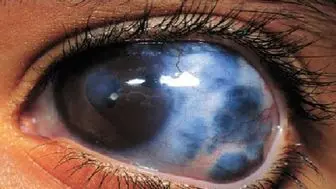 آب سیاه چشم؛ از علائم تا روش‌های درمان 