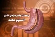 راهنمای جامع جراحی اسلیو معده؛ رایج ترین جراحی لاغری
