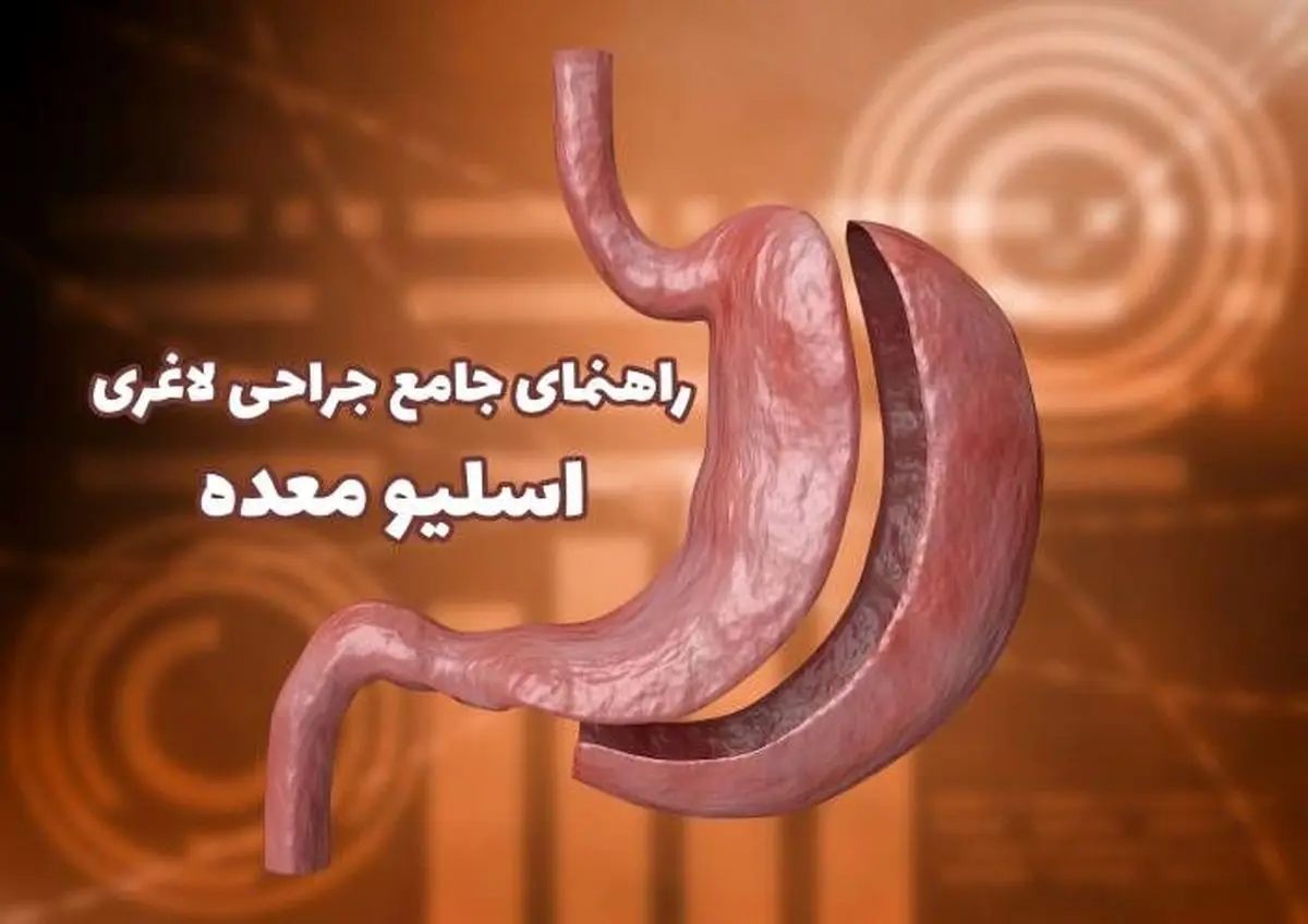 راهنمای جامع جراحی اسلیو معده؛ رایج ترین جراحی لاغری
