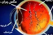 این علائم نشان دهنده بیماری چشم است