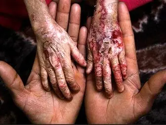 زخم بدن بیماران «EB» رودبار درانتظار مرهم وزیر بهداشت