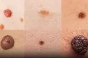 حواس‌تان به این نوع خال‌ها باشد!