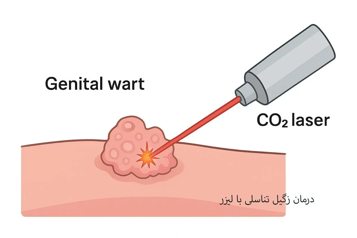 درمان قطعی زگیل تناسلی با لیزر، روشی مدرن، ایمن و بدون درد
