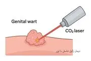 درمان قطعی زگیل تناسلی با لیزر، روشی مدرن، ایمن و بدون درد