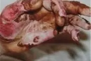 کاهش عمر مفید‏ ایرانیان به دلیل سوختگی