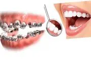 کشیدن دندان برای ارتودنسی و پاسخ به 12 سوال رایج درباره آن


