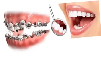 کشیدن دندان برای ارتودنسی و پاسخ به 12 سوال رایج درباره آن

