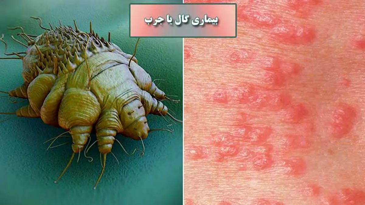 گال چیست و برای درمان آن باید چه کار کرد؟