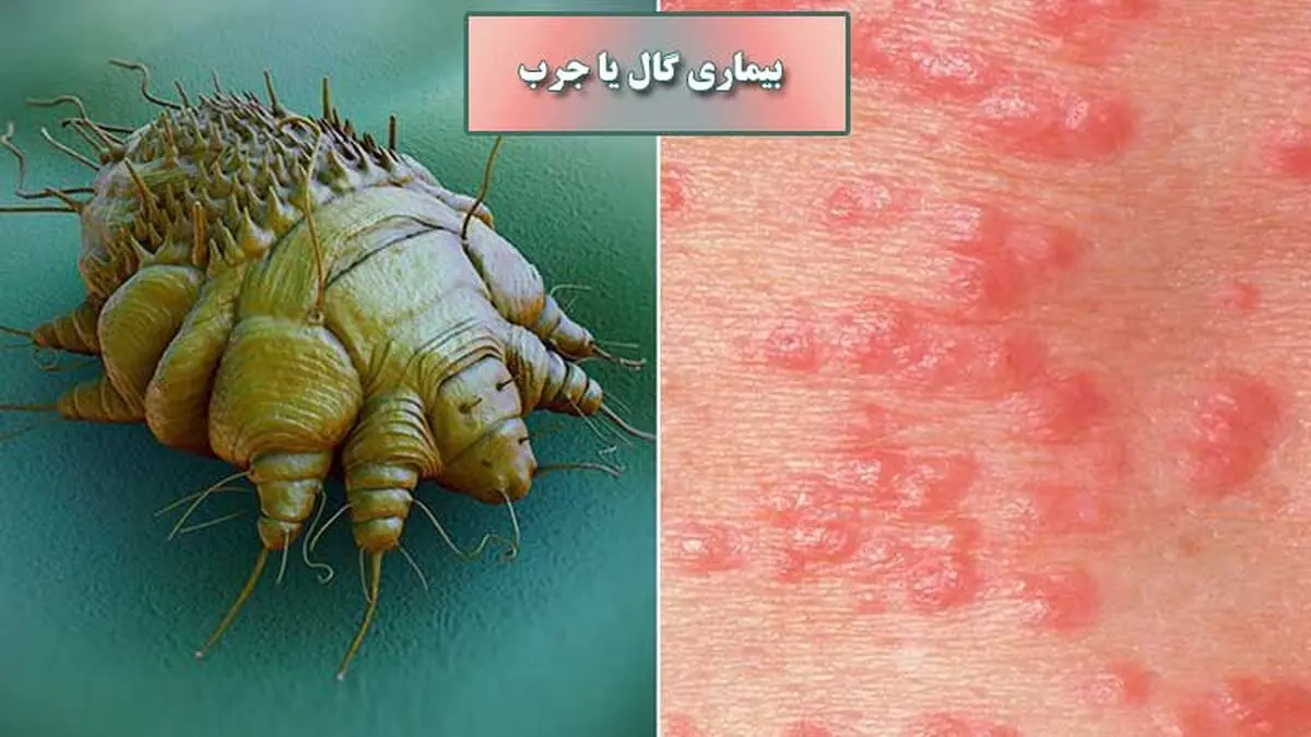 گال چیست و برای درمان آن باید چه کار کرد؟


