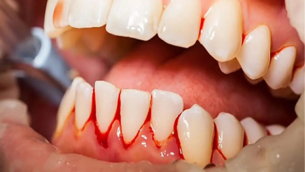 عواقب خطرناک مسواک نزدن را بدانید
