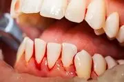 عواقب خطرناک مسواک نزدن را بدانید
