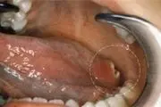 کدام زخم‌های صورت و دهان سرطانی است؟

