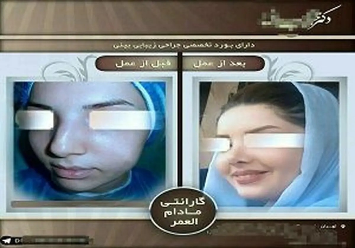 هشداری مهم درباره دستگاه‌های کوچک کننده بینی