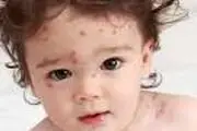 درباره آبله مرغان بیشتر بدانیم