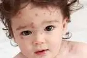 با راه‌های درمان آبله مرغان آشنا شوید
