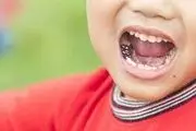 علل پوسیدگی دندان های کودکان