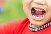 علل پوسیدگی دندان های کودکان
