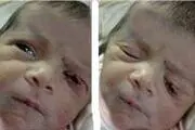 
تیغ جراحی پلک نوزاد را برید +عکس
