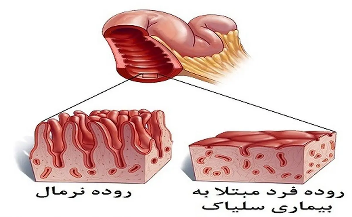 سلیاک، بیماری شایع اما ناشناخته