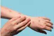 شناسایی علائم جدید آبله میمون
