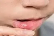 آفت دهان یک نشانه جدی است؛ خود درمانی ممنوع!