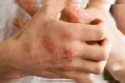 منشا اگزما شناسایی شد
