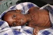 کودک یمنی بر اثر شدت سوءتغذیه جان باخت + تصاویر