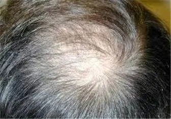 خواص بیشمار روغن کنجد در درمان ریزش مو