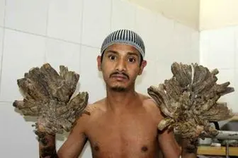 جراحی مردی که انگشتانش مثل درخت رشد می کند+عکس