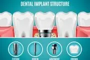 ایمپلنت دندان قیمت (قیمت کاشت دندان)