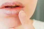 مبارزه با ویروس آنفلوآنزا و تبخال با آدامس لوبیا!
