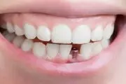 ایمپلنت دندانی مناسب چه کسانی است؟