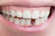 ایمپلنت دندانی مناسب چه کسانی است؟