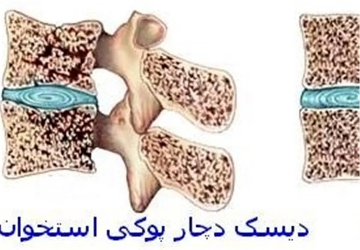 این داروها را کمتر مصرف کنید تا استخوان هایتان نشکند!