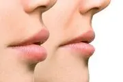 جراحی زیبایی؛ از بزرگ کردن لب‌ها، رسیدیم به کوچک کردن لب‌ها!