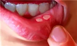 علت بروز آفت دهان چیست؟