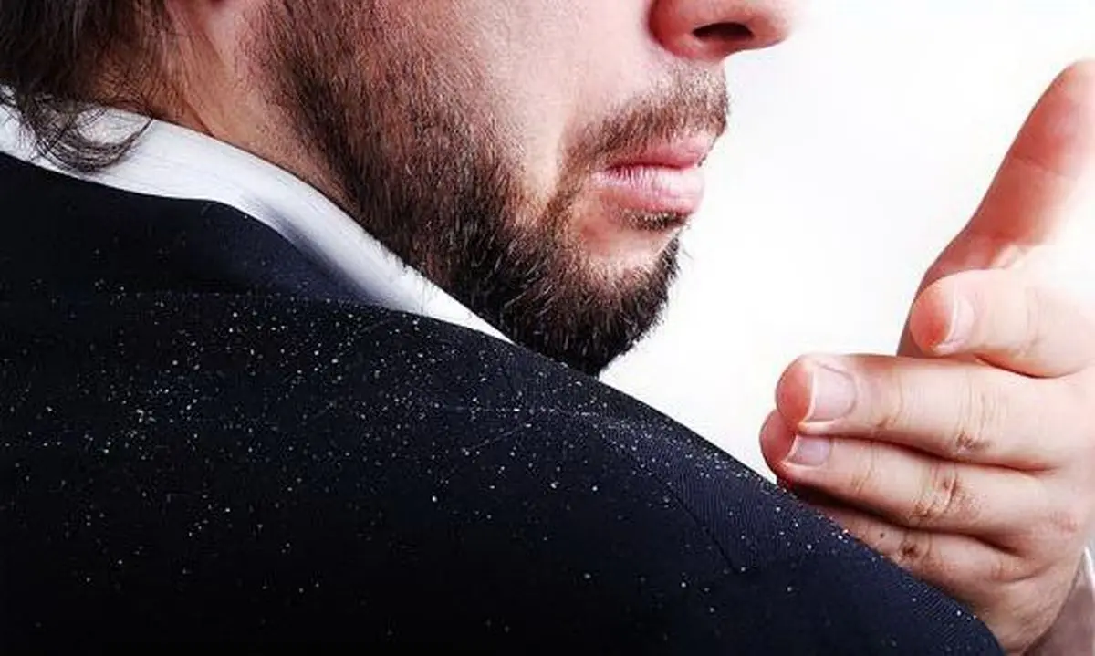 شوره سر را چطور کنترل کنیم؟
