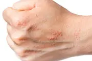 بیماری پسوریازیس چیست؟
