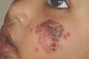 سالک روستایی یک بیماری بومی در مناطق گرمسیری کرمانشاه است