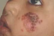 سالک روستایی یک بیماری بومی در مناطق گرمسیری کرمانشاه است