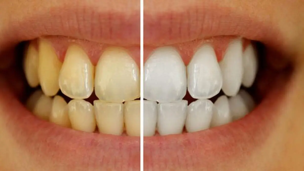 چگونه دندان‌هایی سفید و سالم داشته باشیم؟