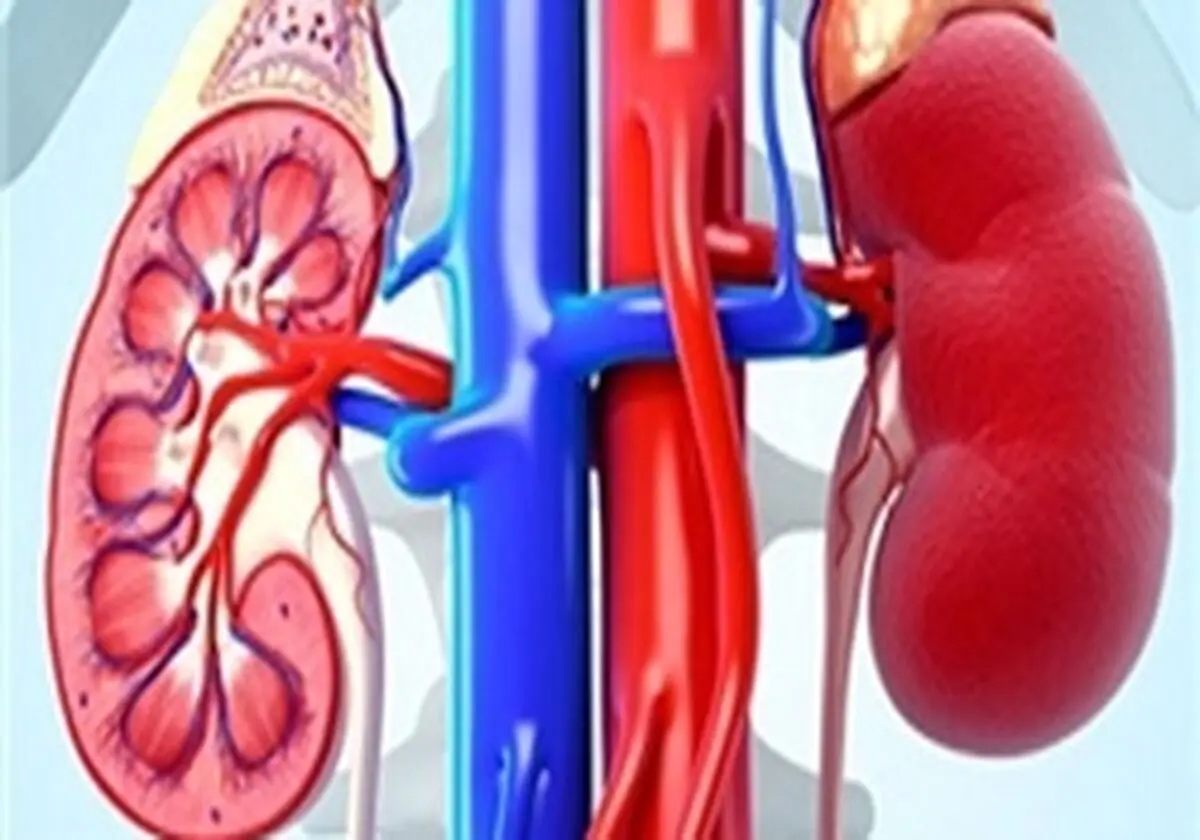 سنگ کلیه چیست و چگونه می توان آن را درمان کرد؟

