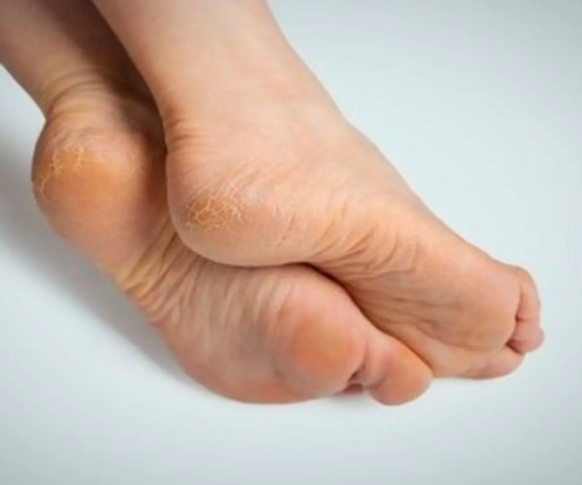 خواب رفتگی کمبود چه ویتامینی در بدن است؟