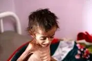 کودکان یمنی غوطه‌ور در قحطی و مرگ