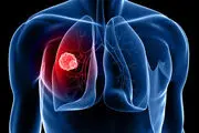 عوامل و راه‌های درمان سرطان ریه را بشناسید