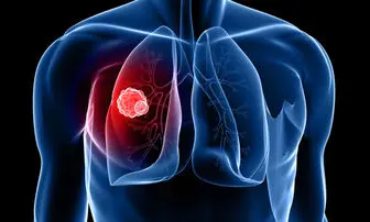 عوامل و راه‌های درمان سرطان ریه را بشناسید