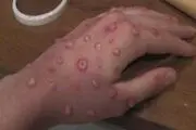آبله میمون به ارتش آمریکا در اروپا رسید
