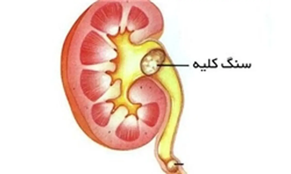 کلیه سالم در رژیم غذایی صحیح